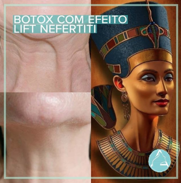 Botox com efeito Lift Nefertiti